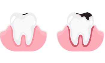 Illustration des différentes phases de la carie