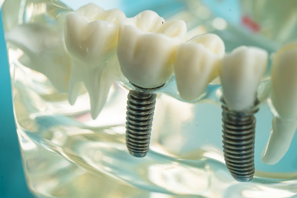 Modèles de dents et d'implants posés dans un socle transparent